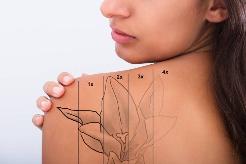 Dangerosité du détatouage laser par laser picosecondes