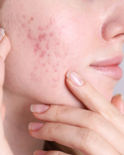 lumiere pulsee pour acne marseille aix carry toulon 