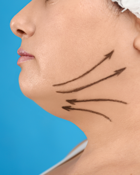 traitement double menton marseille aix toulon carry 