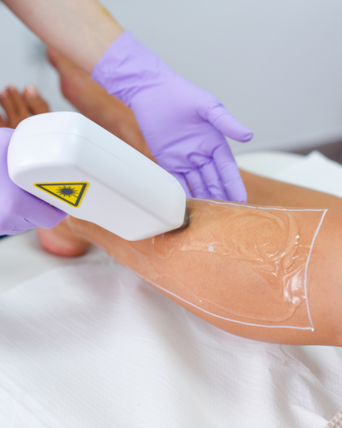 laser diode epilation marseille 