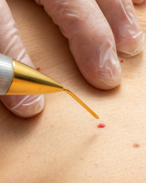 laser angiome marseille aix carry toulon 