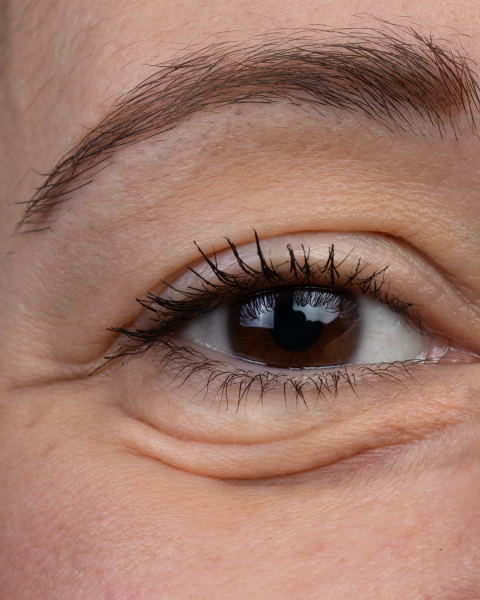 traiter les poches sous les yeux marseille carry toulon aix 