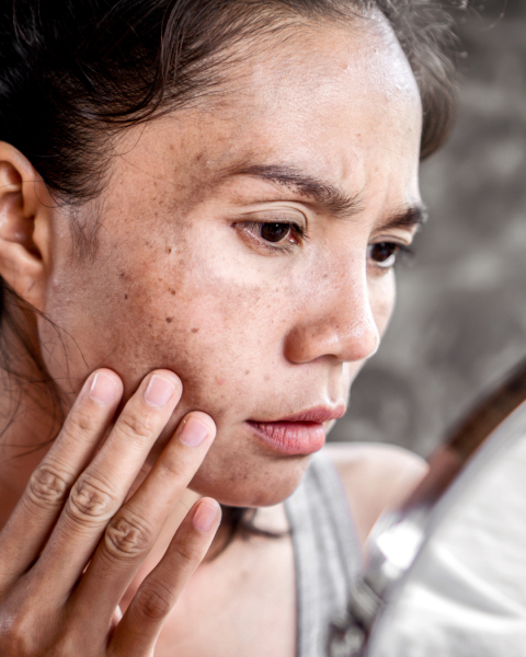 laser picostar tache pigmentaire 