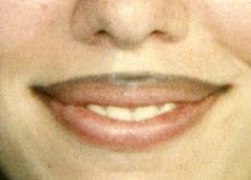 Effacer Tatouage lèvres raté à Marseille