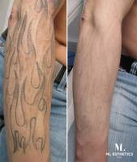 Notre zone d'activité pour ce service Détatouage picolaser unique en France à