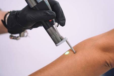 Notre zone d'activité pour ce service Détatouage laser petit prix