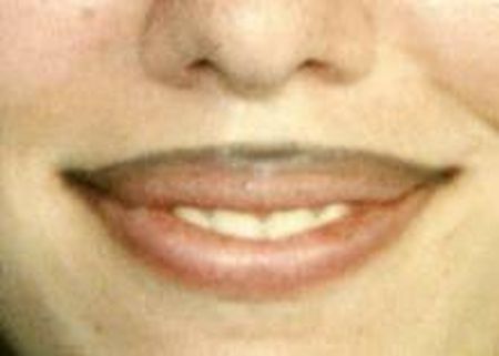 Notre zone d'activité pour ce service Prix pour enlever un tatouage au laser sur